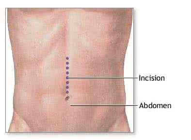 A műtét utáni időszak az appendicitis eltávolítása után: a betegre vonatkozó szabályok